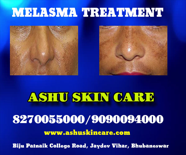 best melasma treatment clinic in bhubaneswar near hitech hospital